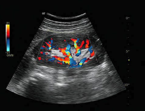 Color-Flow-Darstellung der Niere, aufgenommen mit 4C Schallkopf.