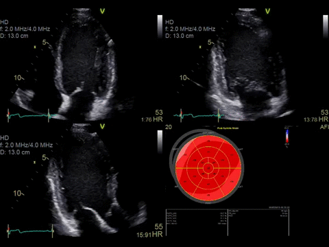 Automated Function Imaging (AFI)