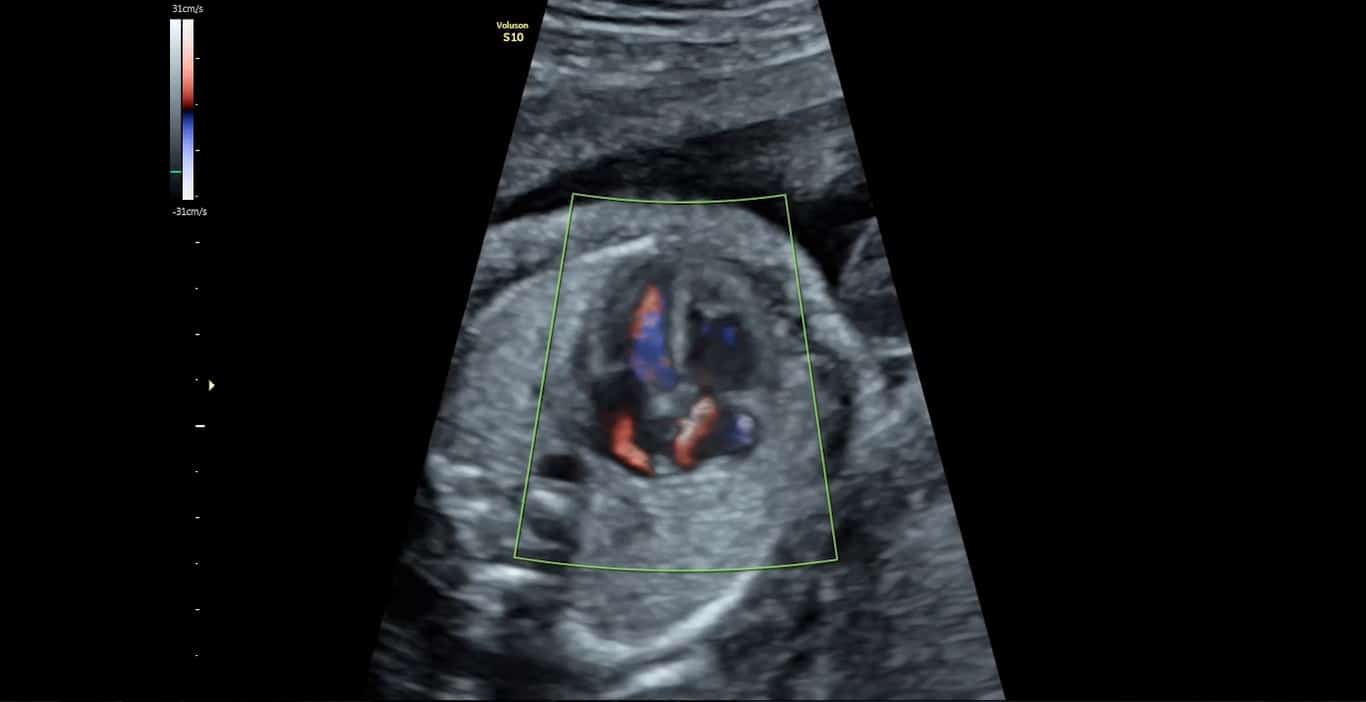 24 Wochen fetales Herz mit HD-Flow